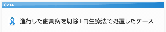 進行した歯周病を切除療法+再生療法で処置したケース