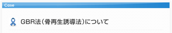 GBR法（骨再生誘導法）について